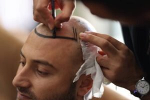 عملية زراعة الشعر للرجال: نتائج الواقع